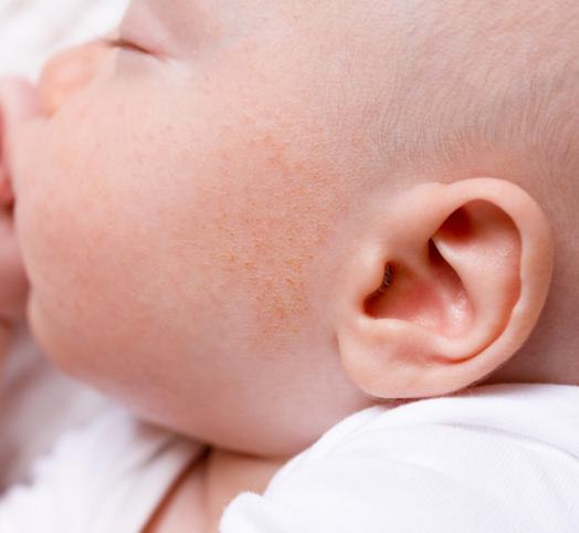 Акне новорожденных на лице - лечение, фото, диагностика.